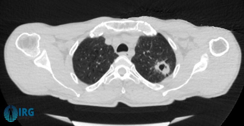 lung biopsy