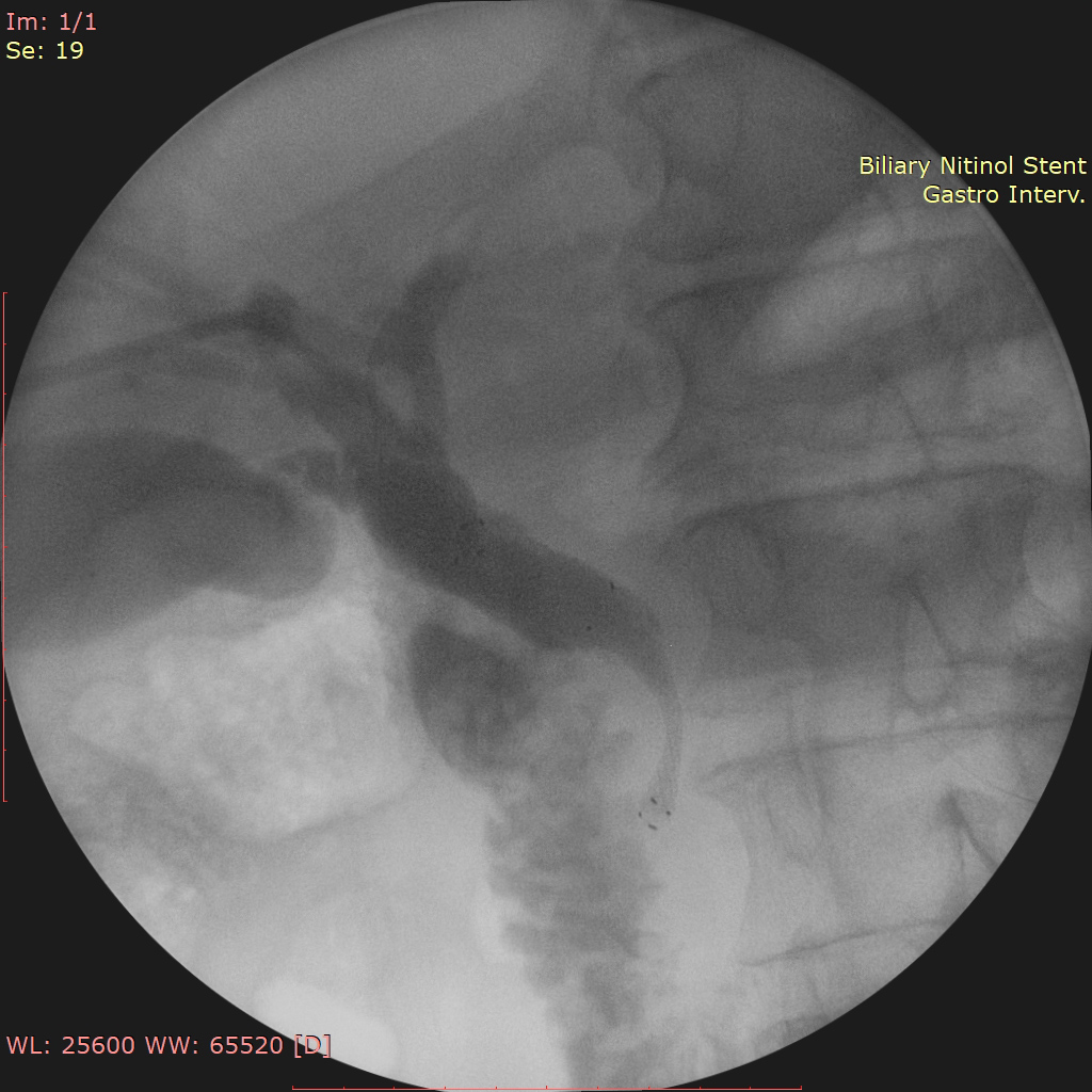 pancreas-stent