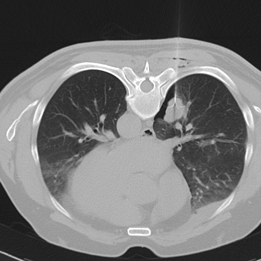 Radiofrequency ablation of lung tumour