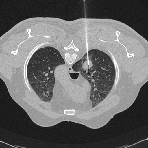 CT guided lung biopsy