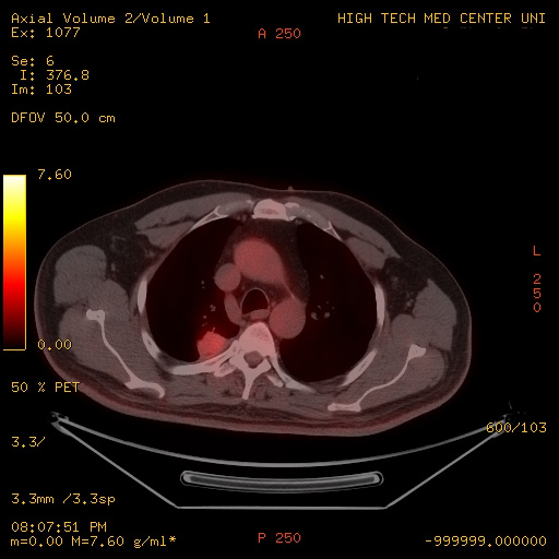 PET-CT, lung