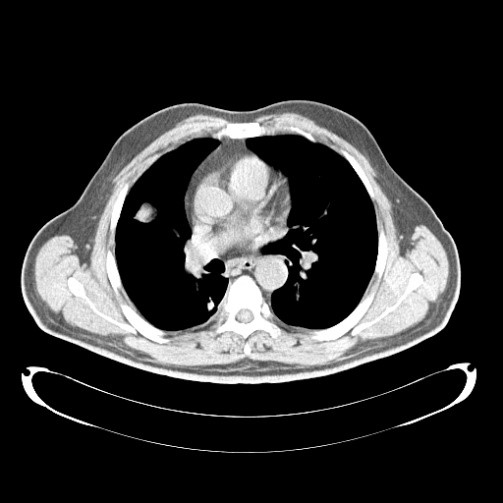 lung follow up CT