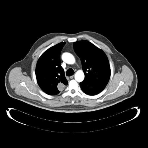 lung folow up CT after RFA