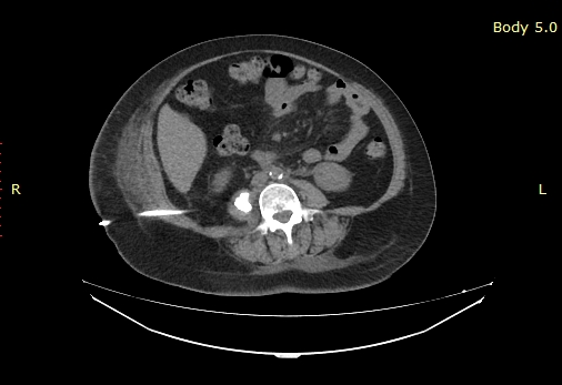 Ct guided abscess drain