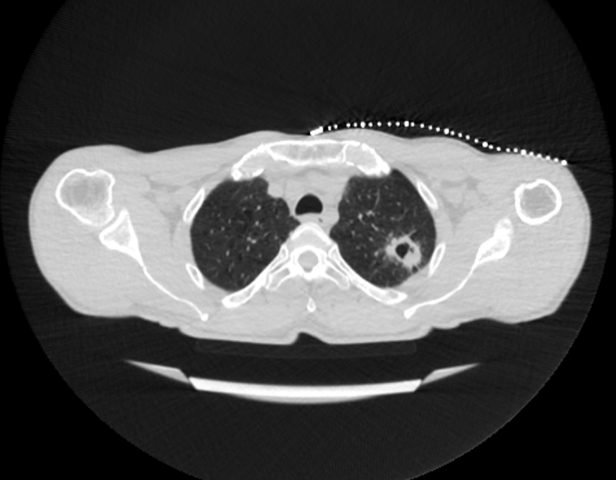 CT guided abscess drain